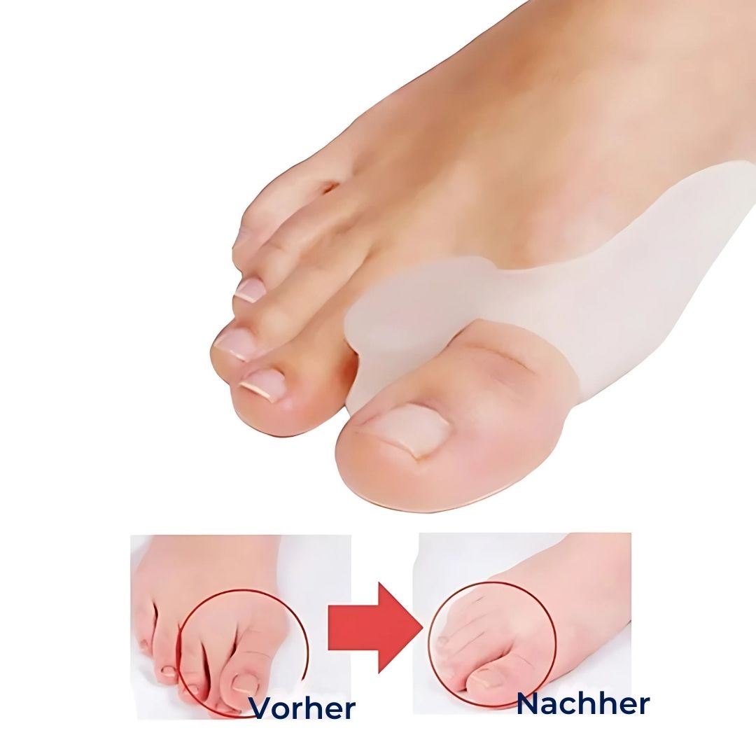 BunionGuard Exklusiv für Hallux Valgus | Silikonschutz mit Zehenspreizer – Schmerzlinderung und Korrigierende Anpassung